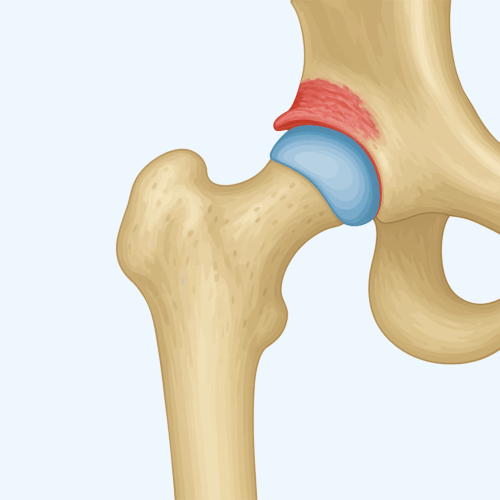 heupimpingement